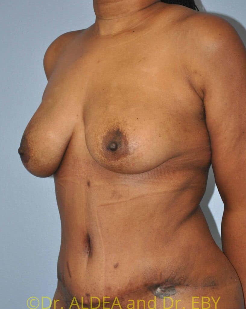 After Image: Fat Transfer to Breasts #796 - left-front-oblique