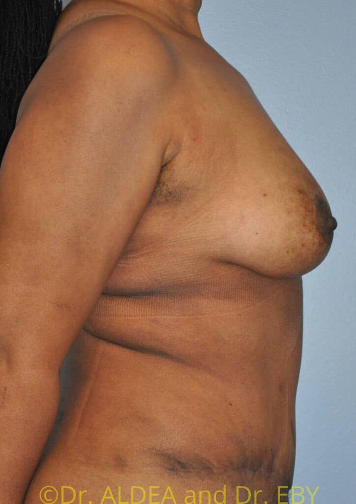 After Image: Fat Transfer to Breasts #796 - right-side