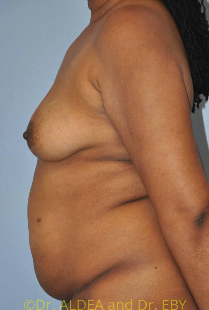 Before Image: Fat Transfer to Breasts #796 - left-side
