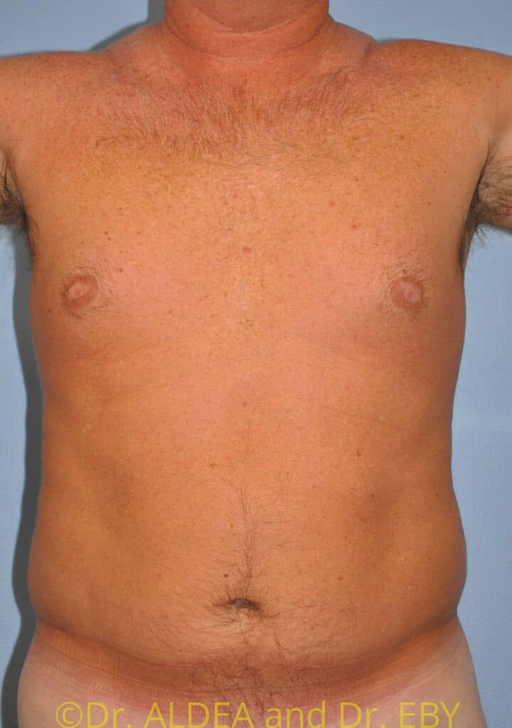 Before Image: Gynecomastia #441 - front