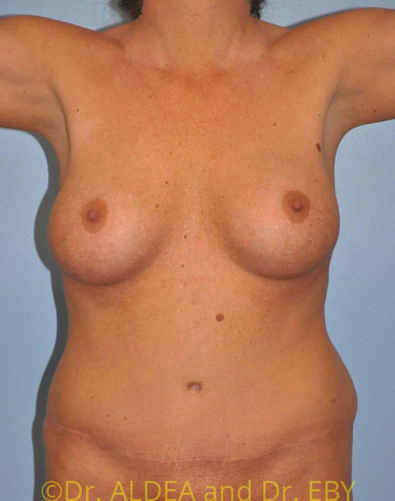 Before Image: Liposuction #928 - front