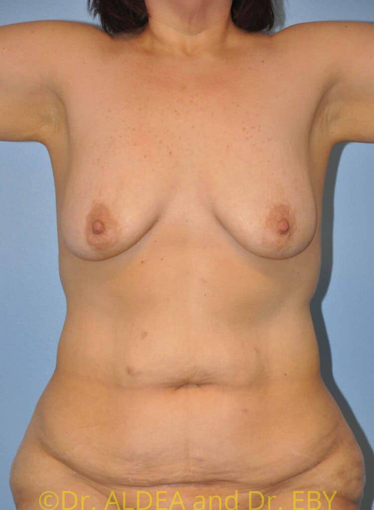 Before Image: Mommy Makeover #343 - front