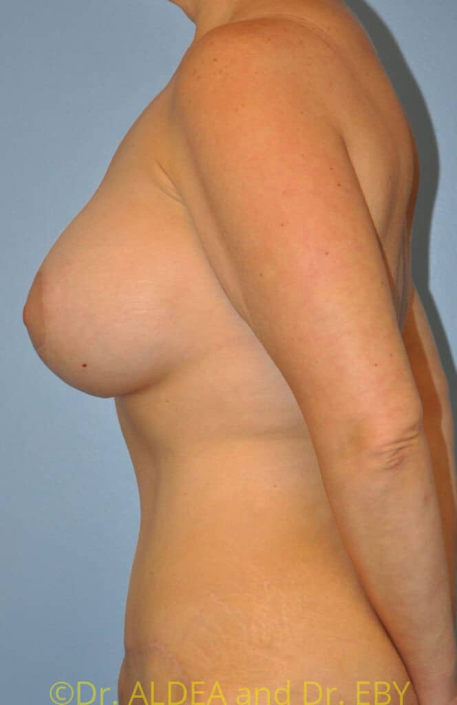 After Image: Mommy Makeover #343 - left-side