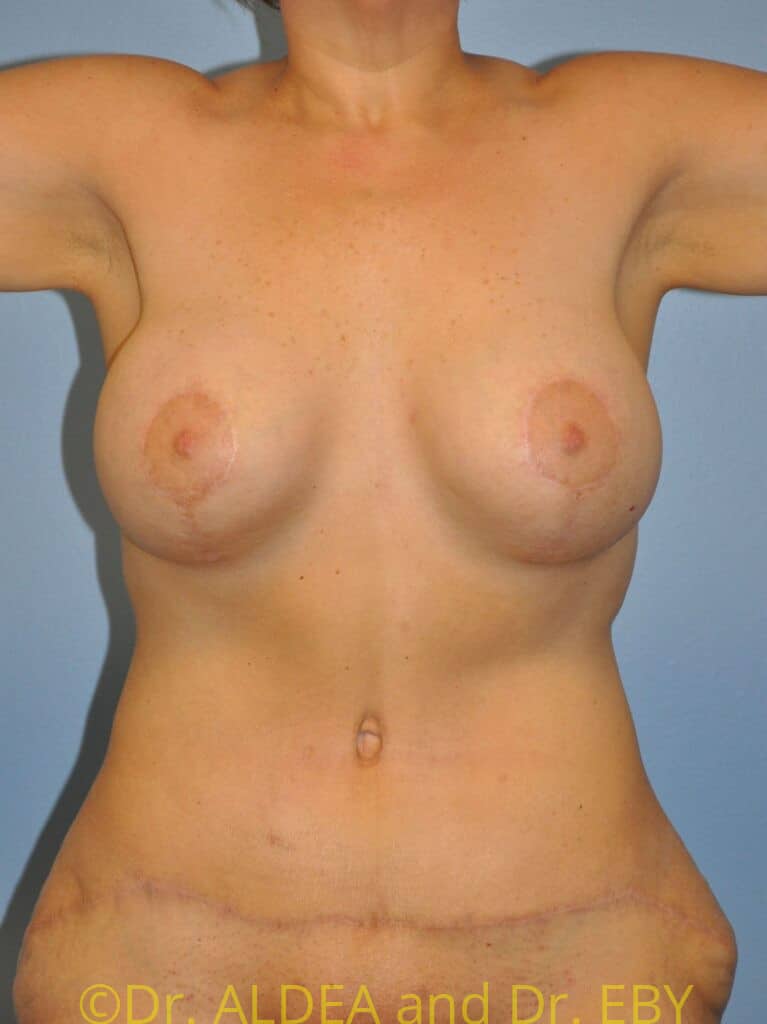After Image: Mommy Makeover #343 - front