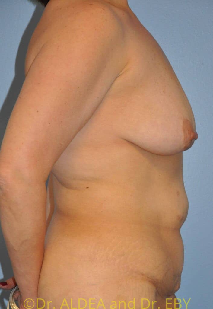 Before Image: Mommy Makeover #343 - right-side