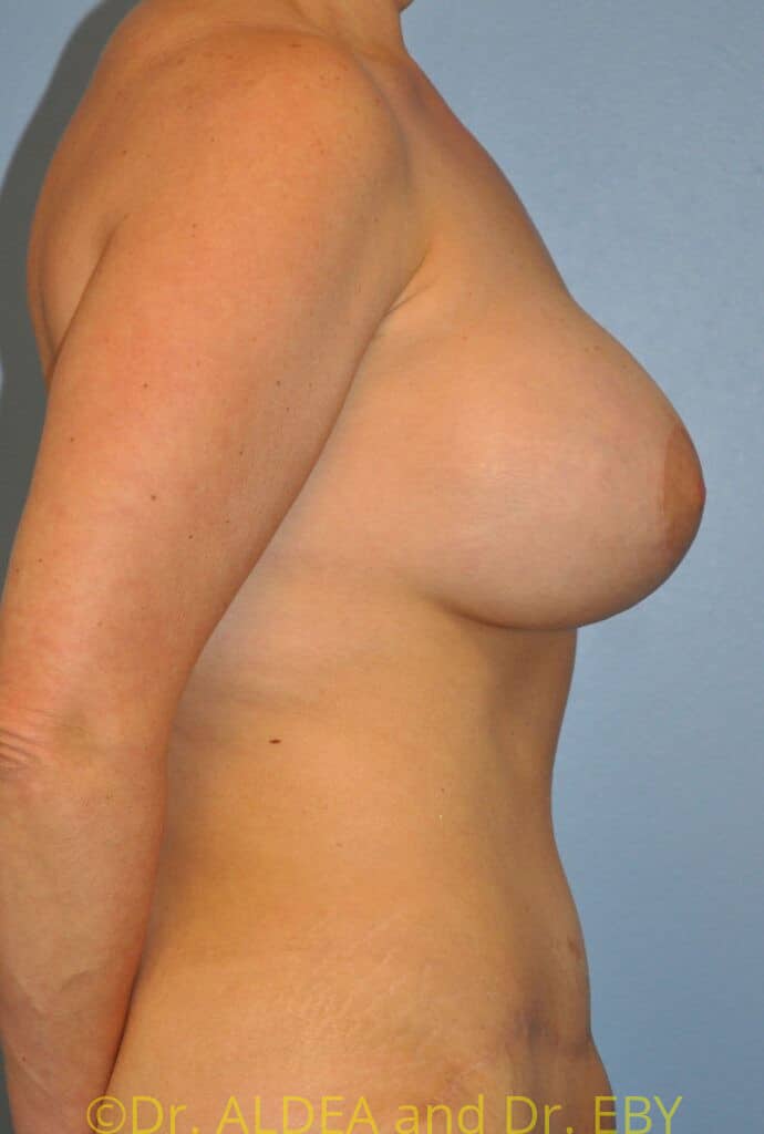 After Image: Mommy Makeover #343 - right-side