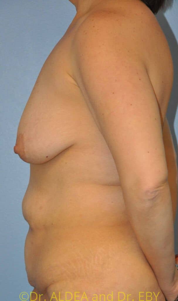 Before Image: Mommy Makeover #343 - left-side