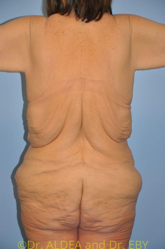 Before Image: Weight loss (MWL) Butt and Thigh Lift #297 - back