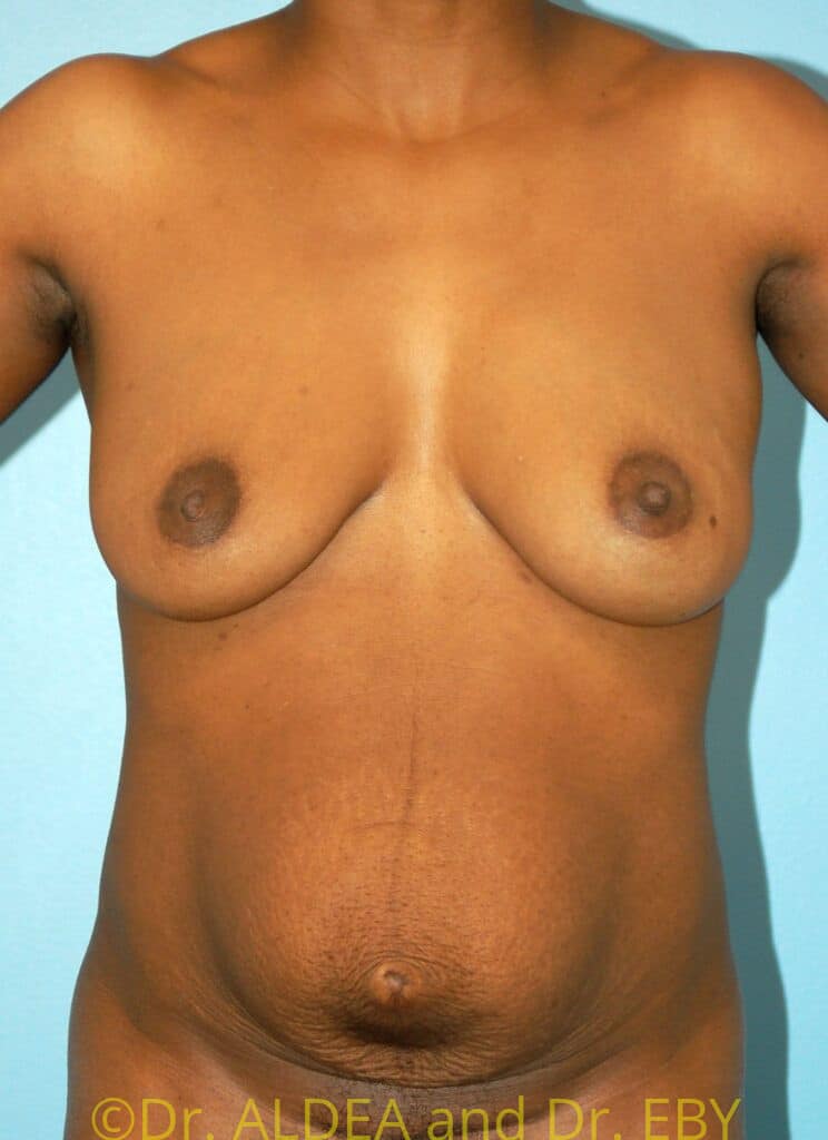 Before Image: Tummy Tuck #783 - front