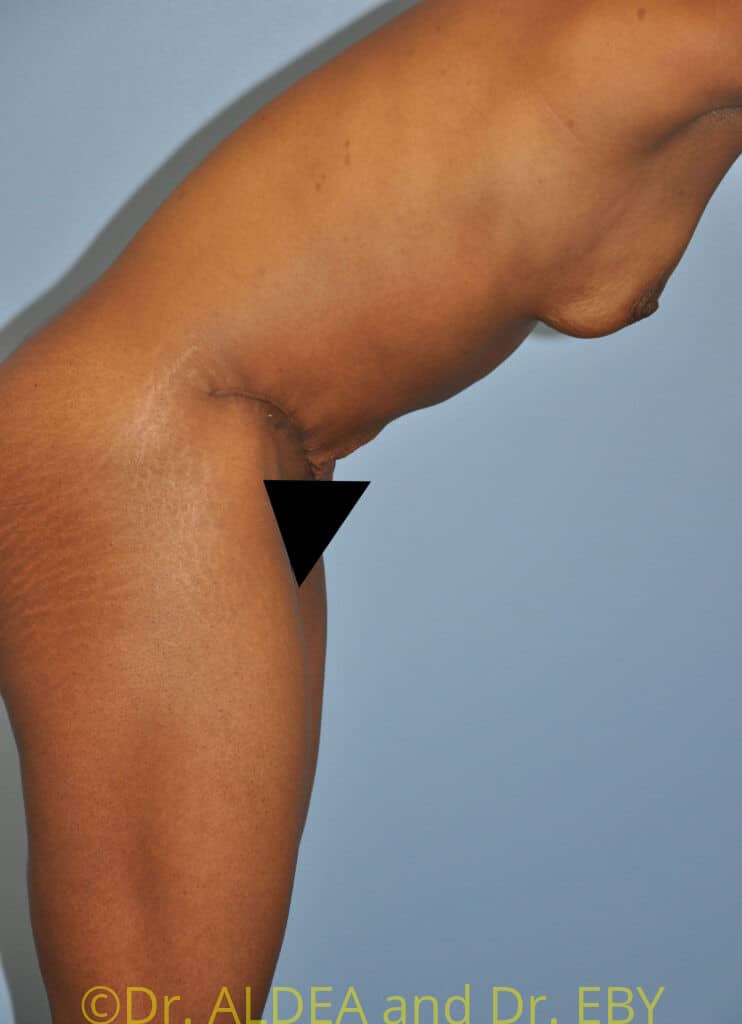 After Image: Tummy Tuck #783 - other