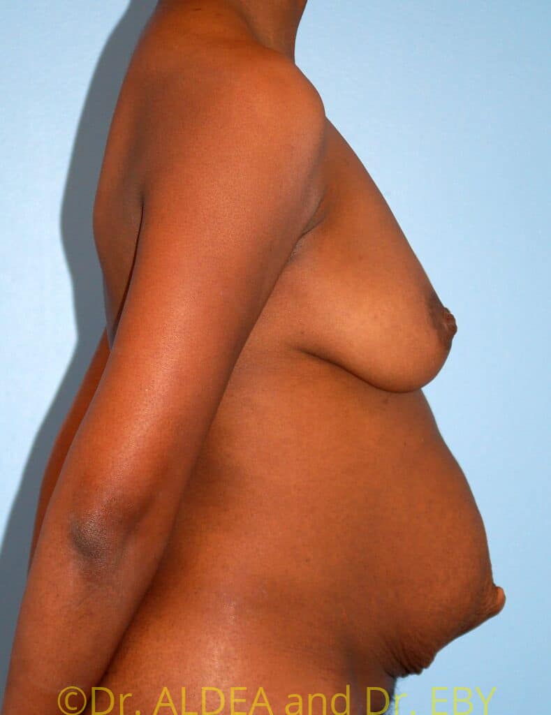 Before Image: Tummy Tuck #783 - right-side