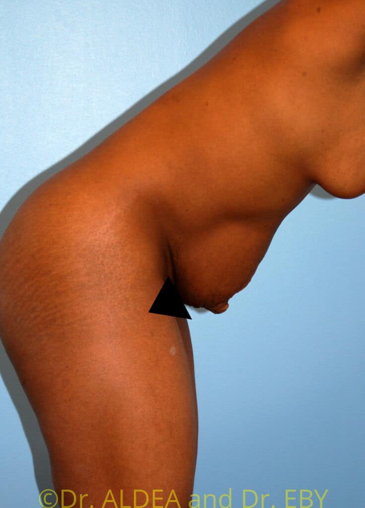 Before Image: Tummy Tuck #783 - other