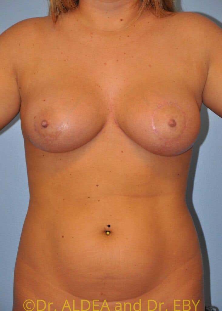 After Image: Breast Augmentation w/ Lift #413 - front