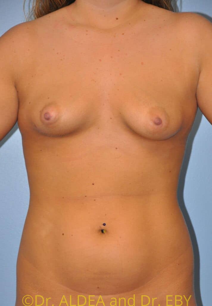 Before Image: Breast Augmentation w/ Lift #413 - front