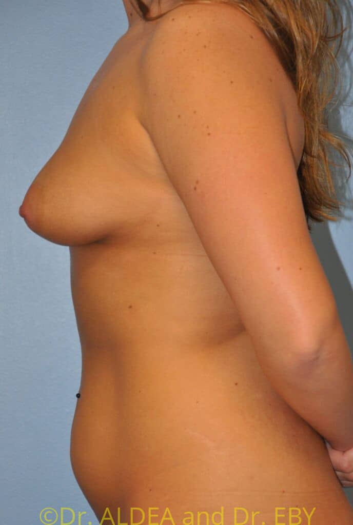 Before Image: Breast Augmentation w/ Lift #413 - left-side