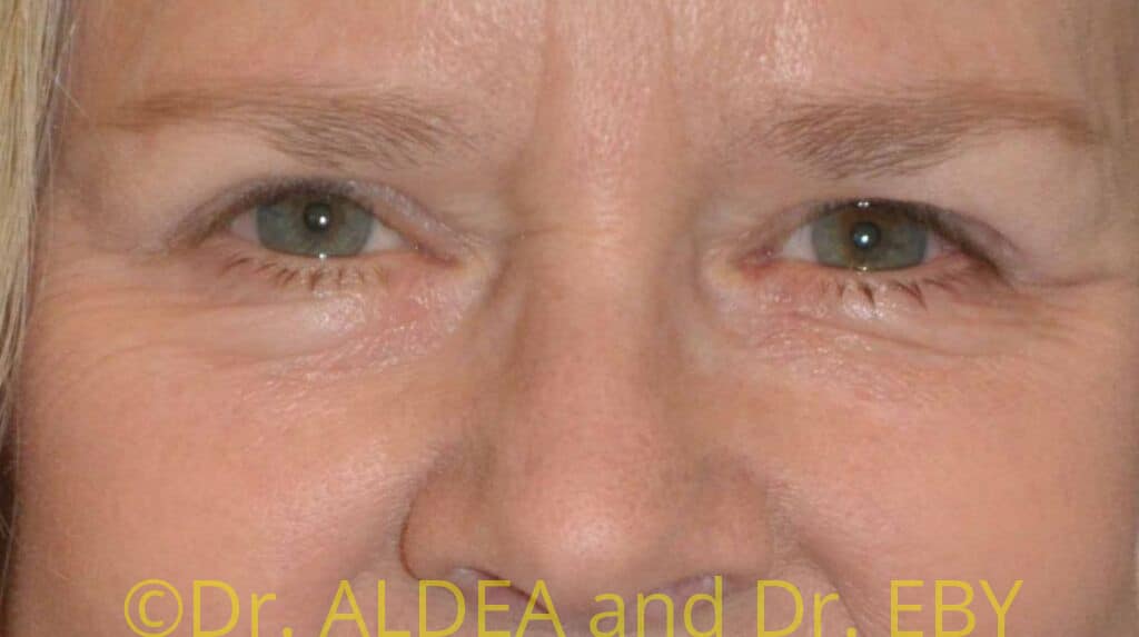 After Image: Blepharoplasty #049 - front