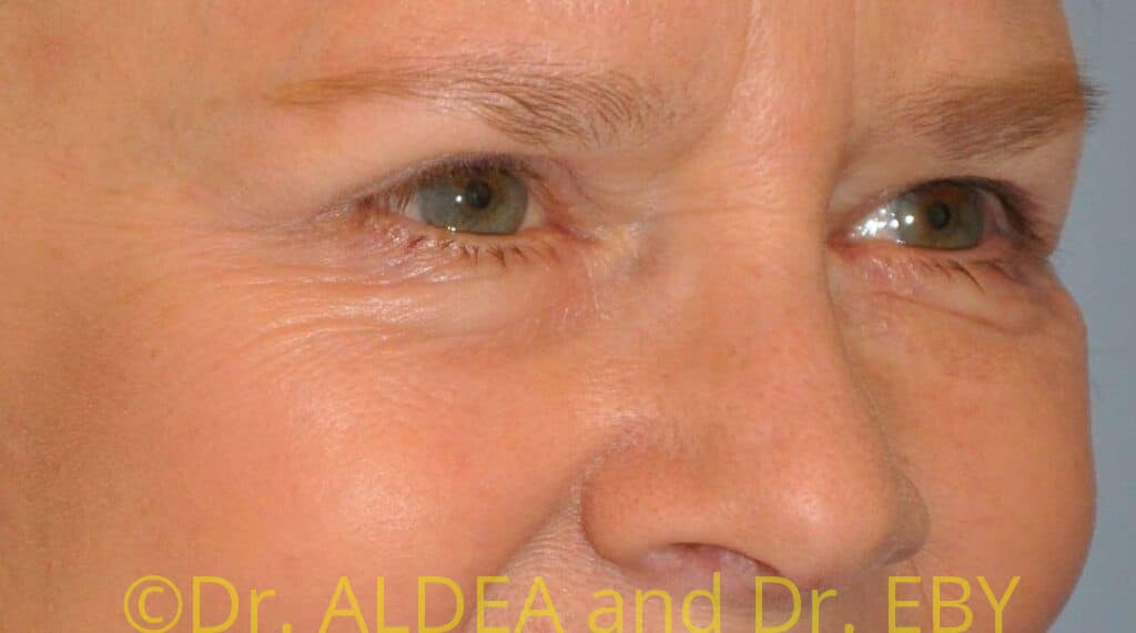 After Image: Blepharoplasty #049 - right-front-oblique