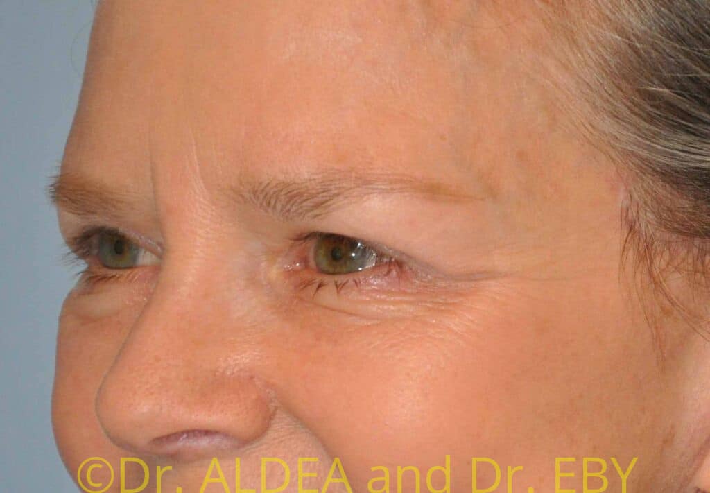 After Image: Blepharoplasty #049 - left-front-oblique
