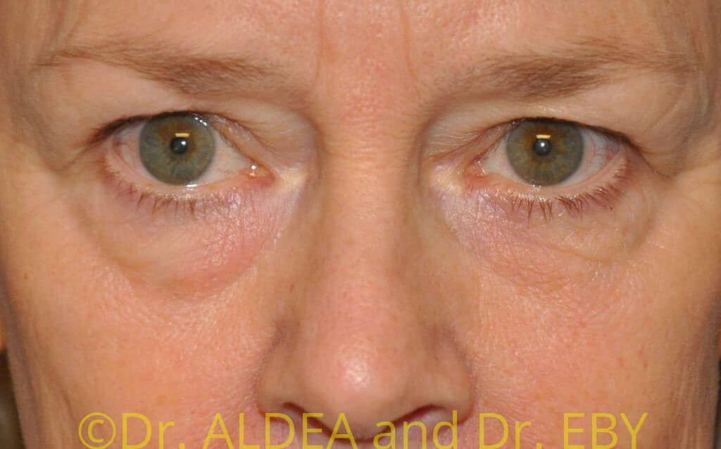Before Image: Blepharoplasty #049 - front