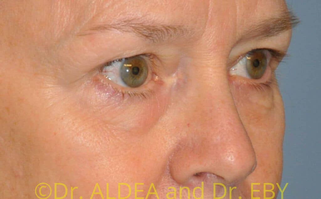 Before Image: Blepharoplasty #049 - right-front-oblique