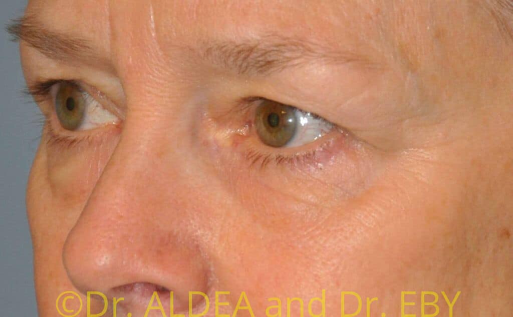 Before Image: Blepharoplasty #049 - left-front-oblique