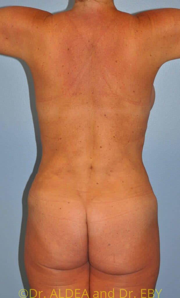 After Image: Back Scoop Liposuction #930 - back