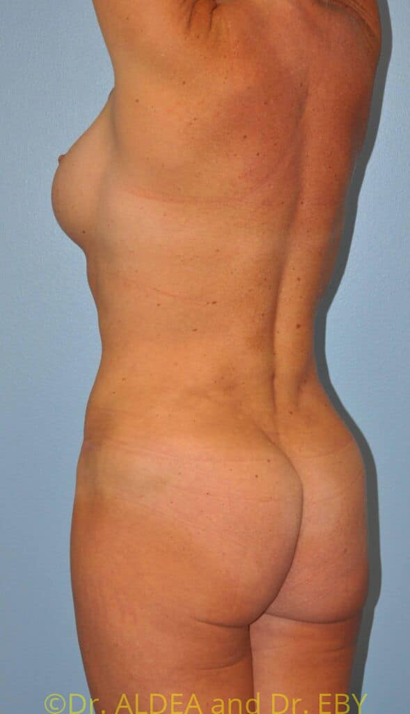 After Image: Back Scoop Liposuction #930 - left-back-oblique