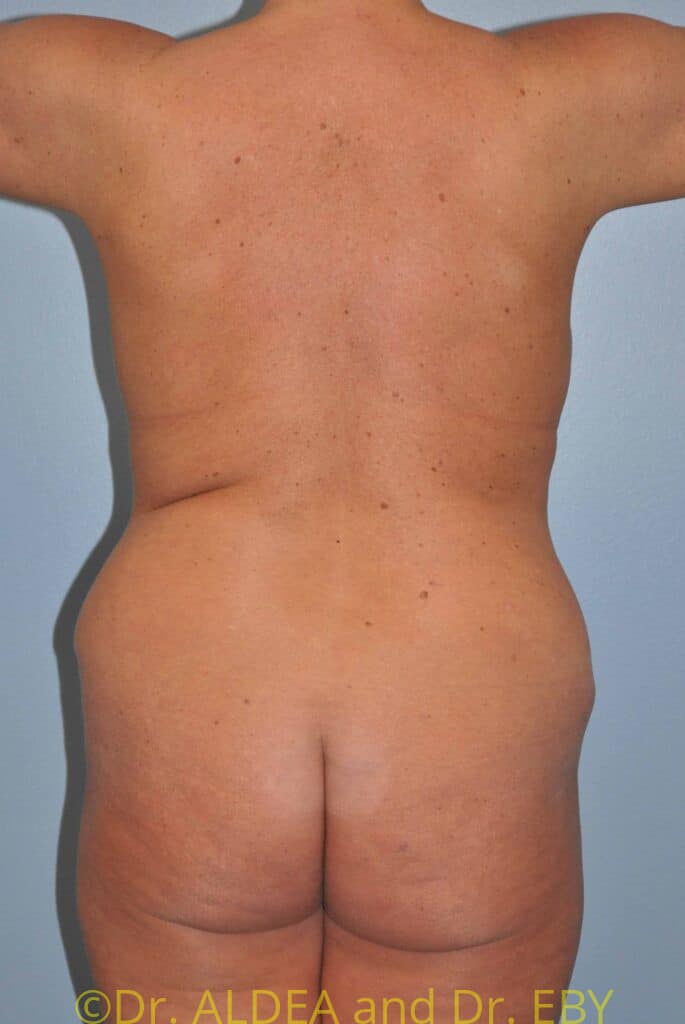 Before Image: Back Scoop Liposuction #930 - back