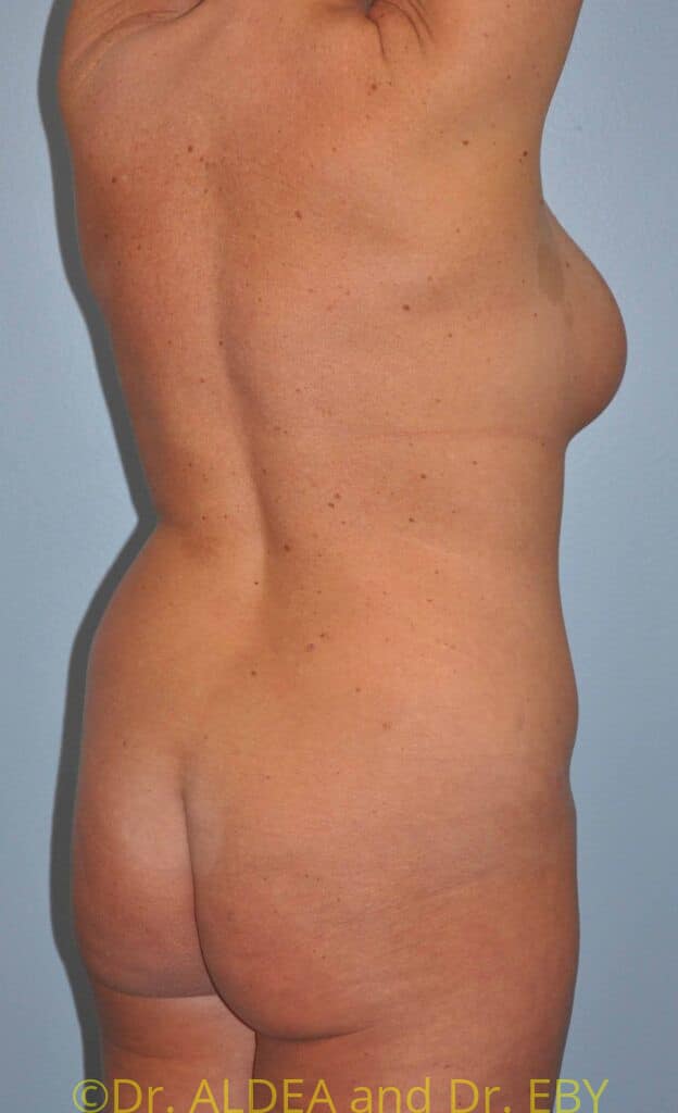 Before Image: Back Scoop Liposuction #930 - right-back-oblique