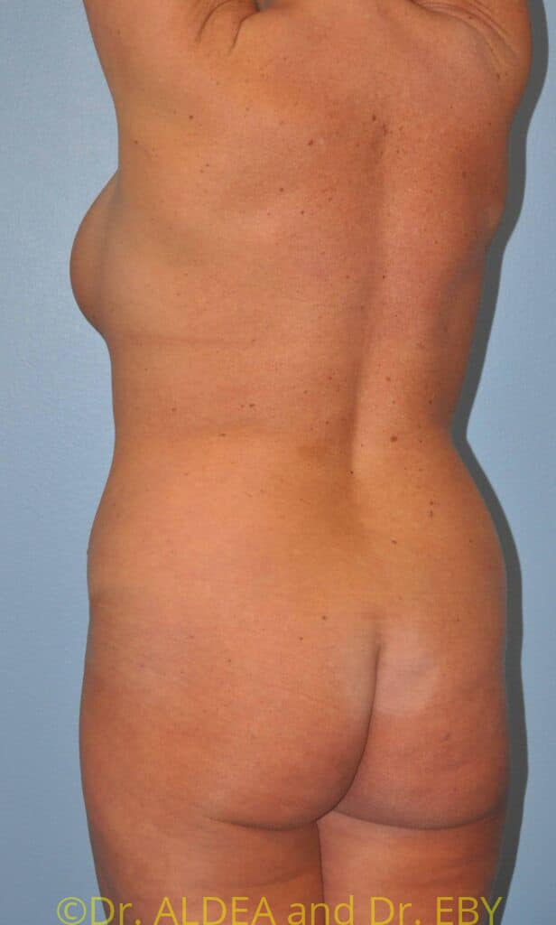 Before Image: Back Scoop Liposuction #930 - left-back-oblique