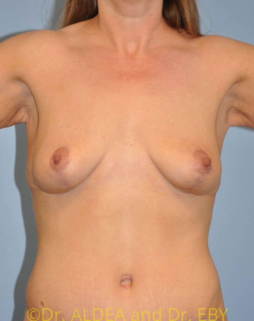 After Image: Short Scar Breast Lift (Mastopexy) #641 - front