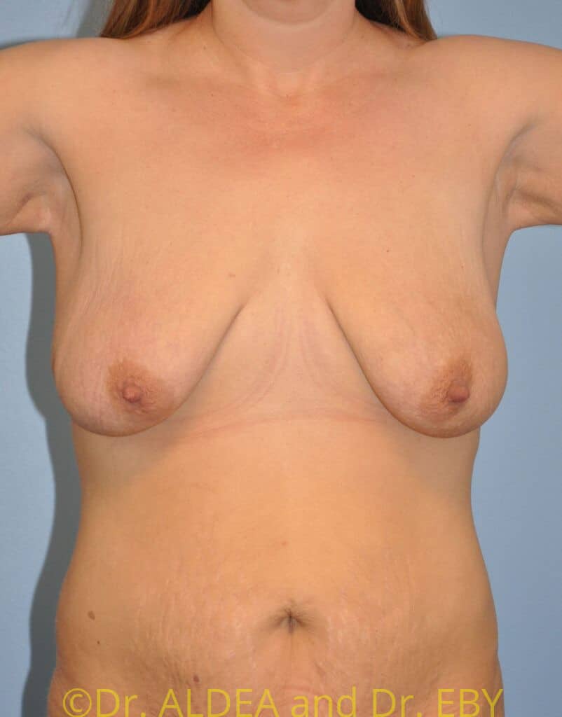Before Image: Short Scar Breast Lift (Mastopexy) #641 - front