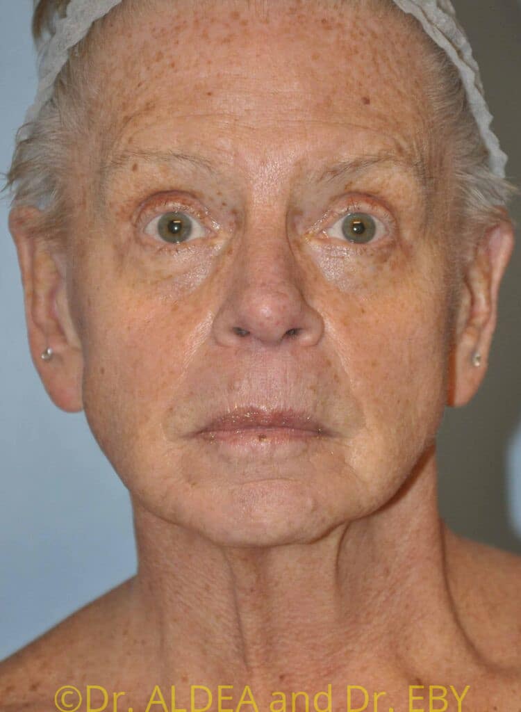 Before Image: Facelift #450 - front