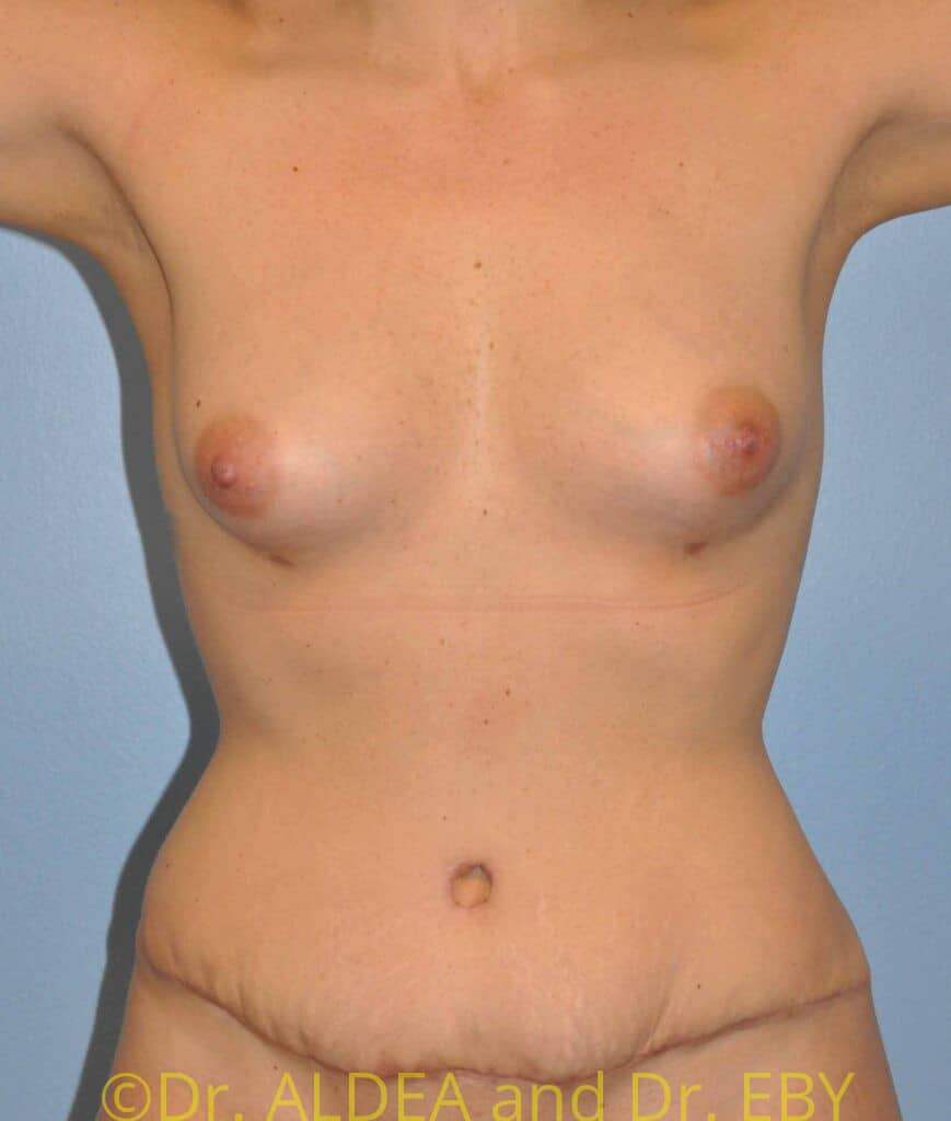 After Image: Fat Transfer to Breasts #765 - front