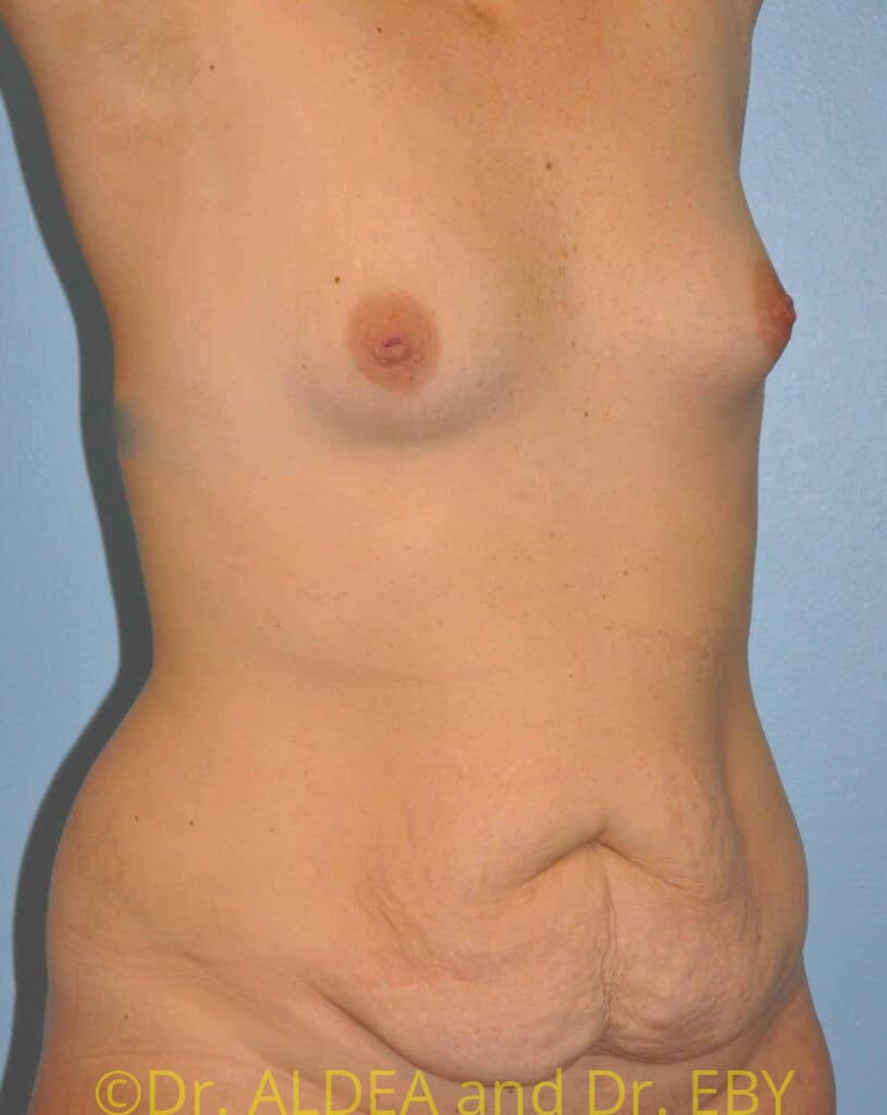 Before Image: Fat Transfer to Breasts #765 - right-front-oblique