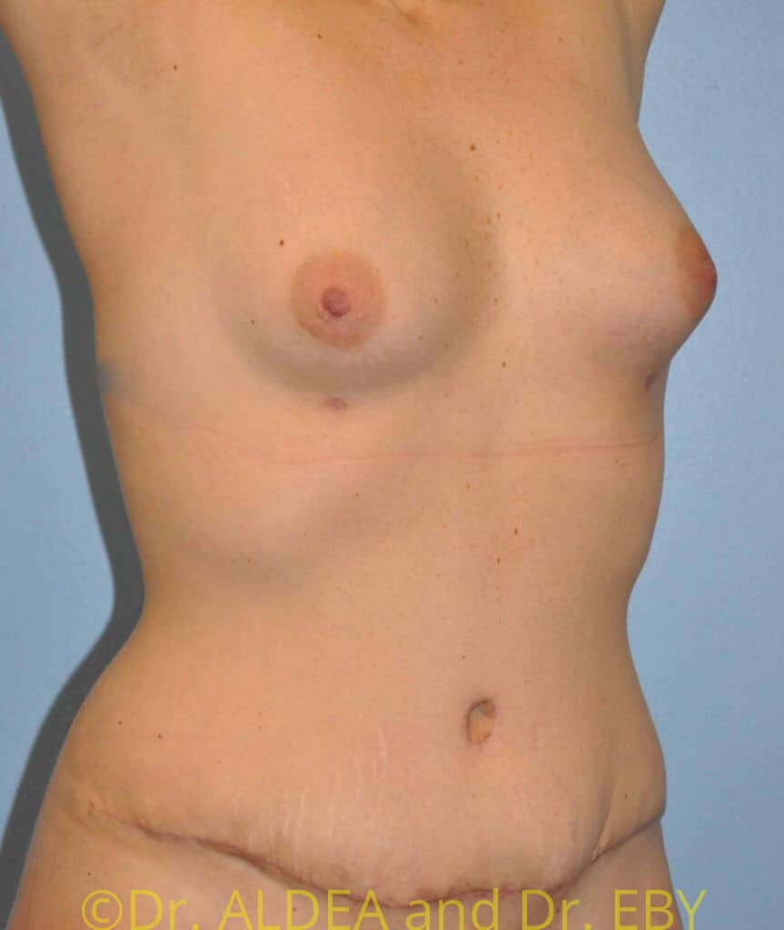 After Image: Fat Transfer to Breasts #765 - right-front-oblique