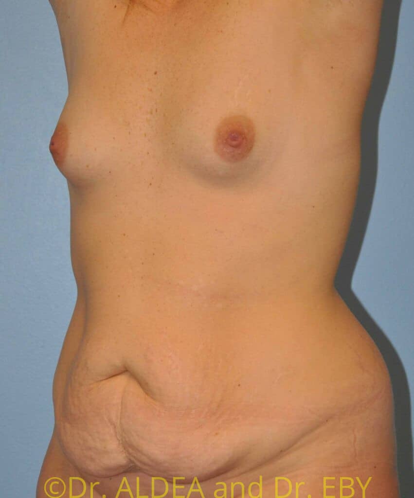 Before Image: Fat Transfer to Breasts #765 - left-front-oblique