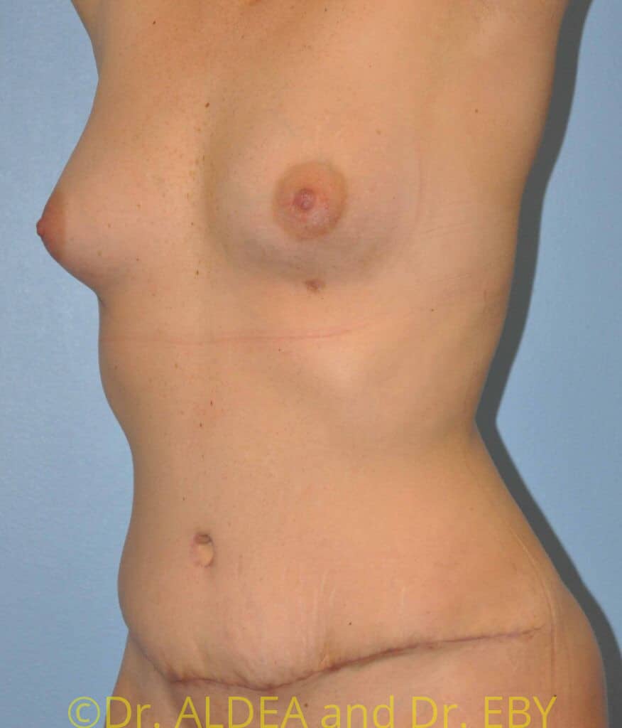 After Image: Fat Transfer to Breasts #765 - left-front-oblique