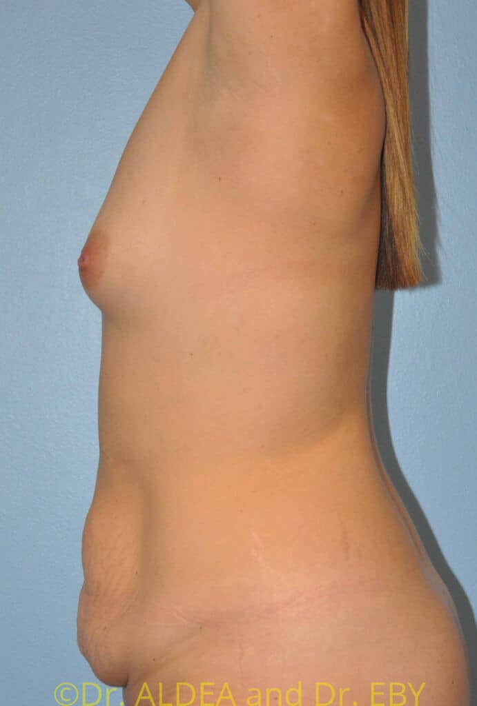 Before Image: Fat Transfer to Breasts #765 - left-side