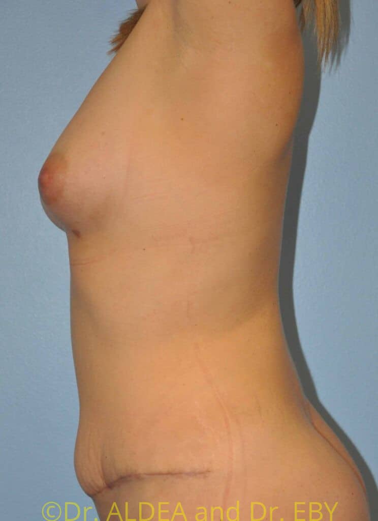After Image: Fat Transfer to Breasts #765 - left-side