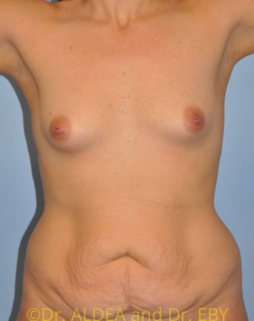 Before Image: Fat Transfer to Breasts #765 - front