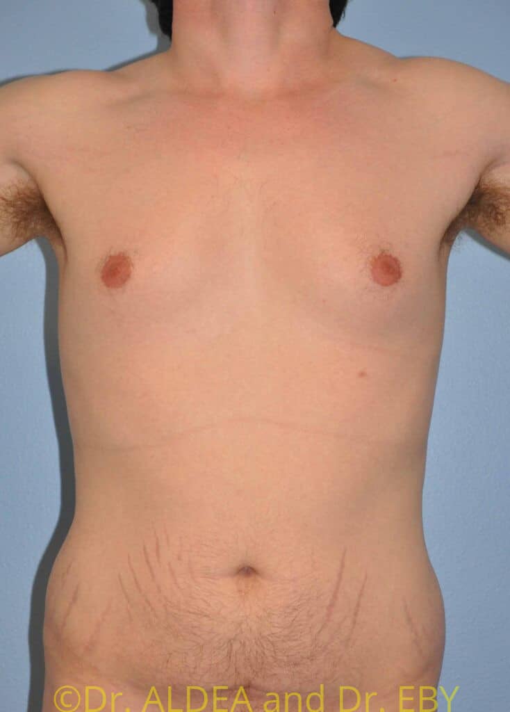 Before Image: Gynecomastia #639 - front