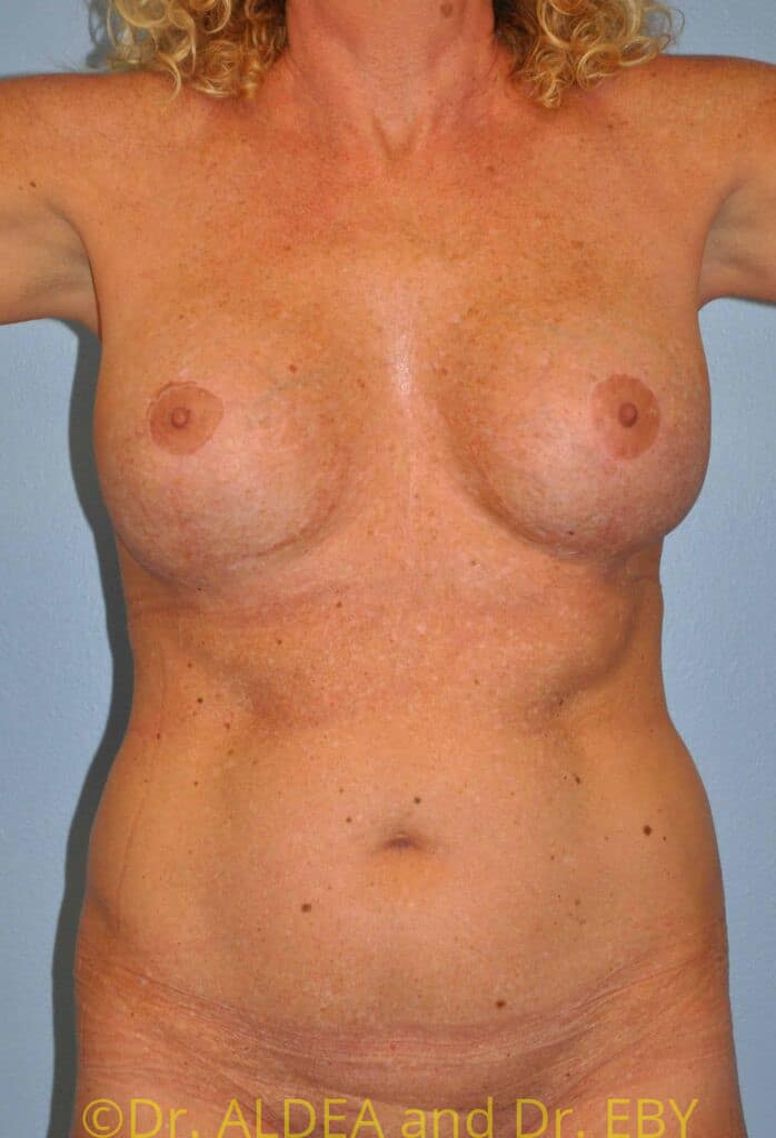 Before Image: Liposuction #181 - front