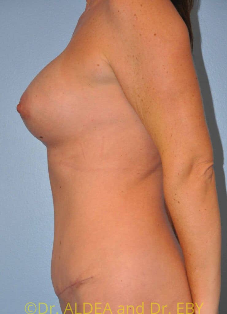 After Image: Mommy Makeover #481 - left-side