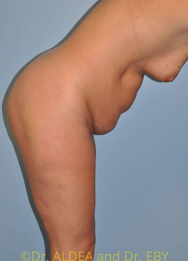 Before Image: Mommy Makeover #481 - other