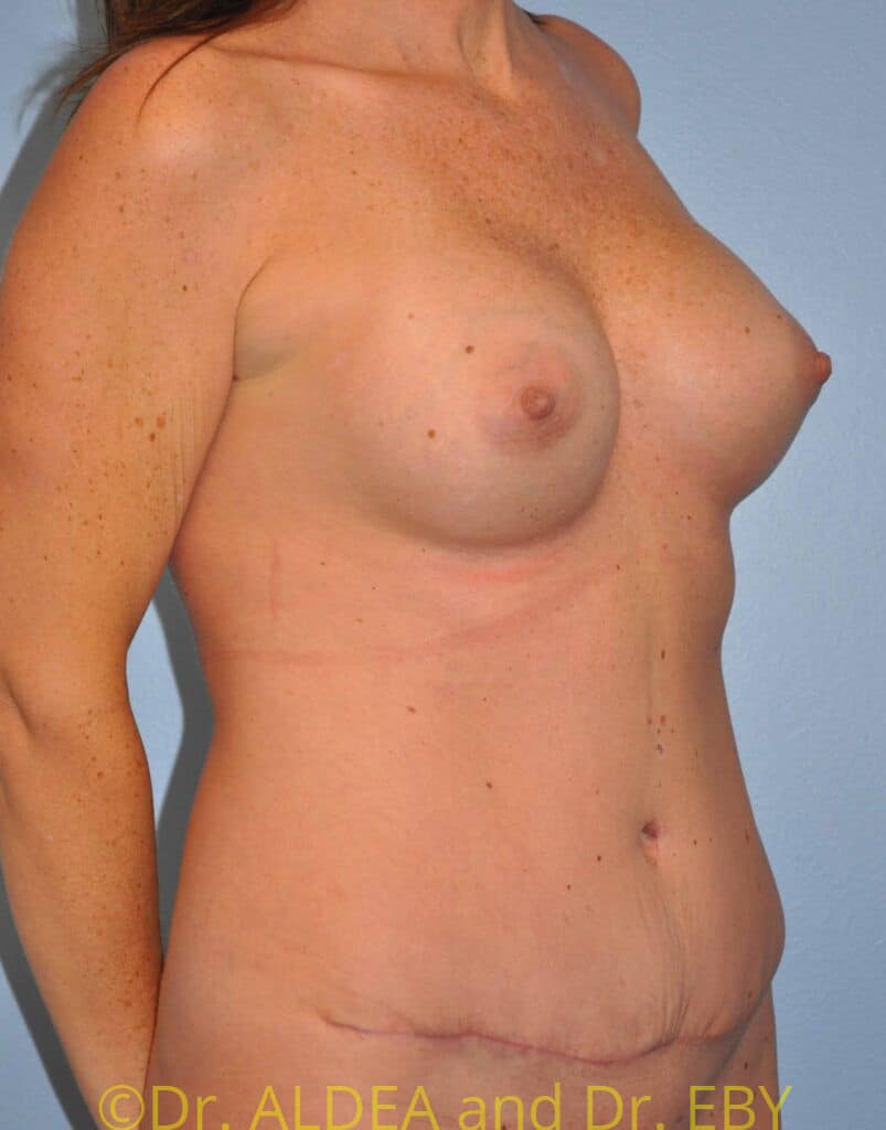 After Image: Mommy Makeover #481 - right-front-oblique