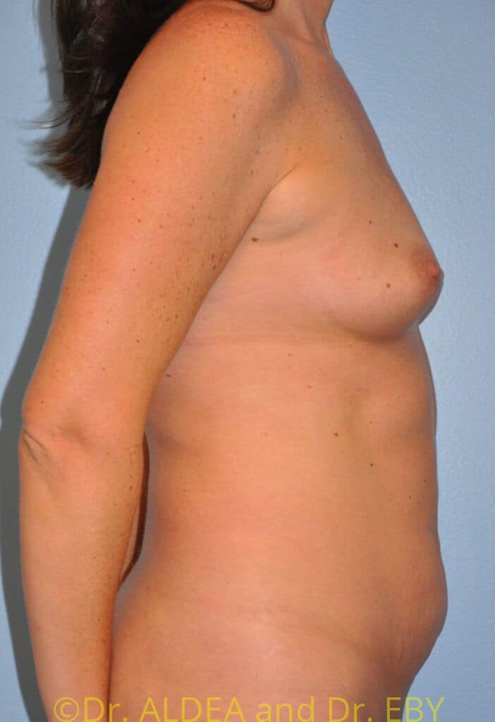 Before Image: Mommy Makeover #481 - right-side