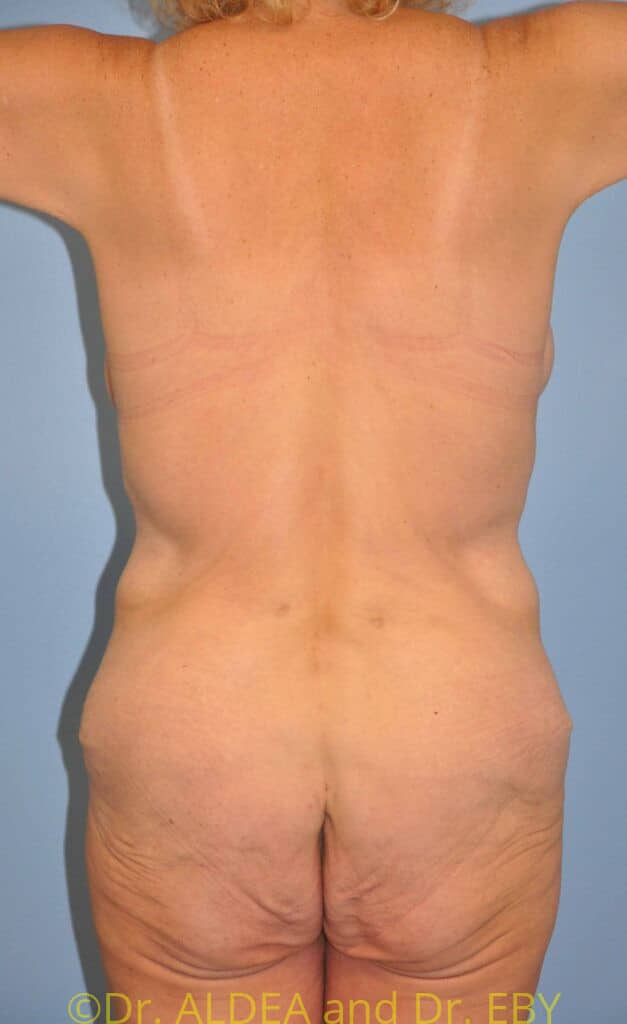 Before Image: Weight loss (MWL) Butt and Thigh Lift #276 - back