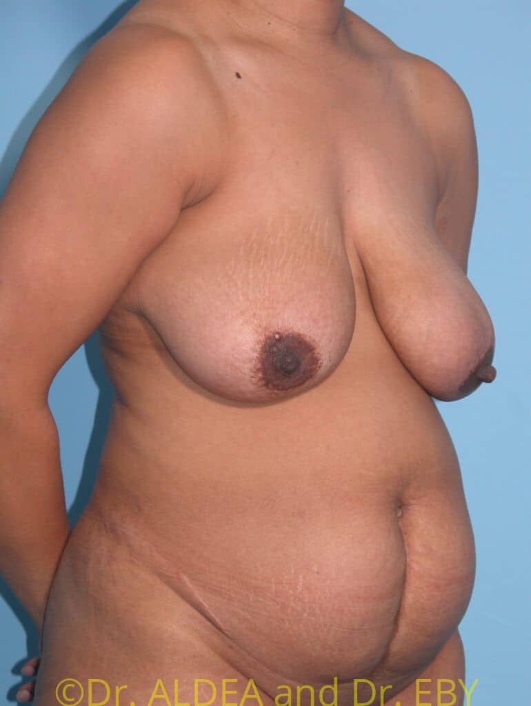 Before Image: Tummy Tuck #333 - right-front-oblique