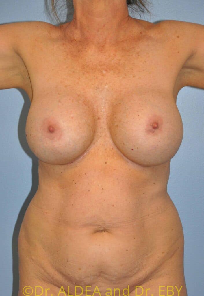 Before Image: Lipoabdominoplasty #578 - front